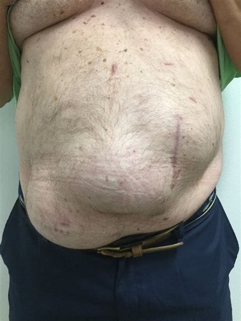 Lift your face. . Epigastric hernia after tummy tuck